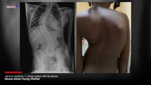 11-Year-Old Girl Needs Urgent Spine Surgery 